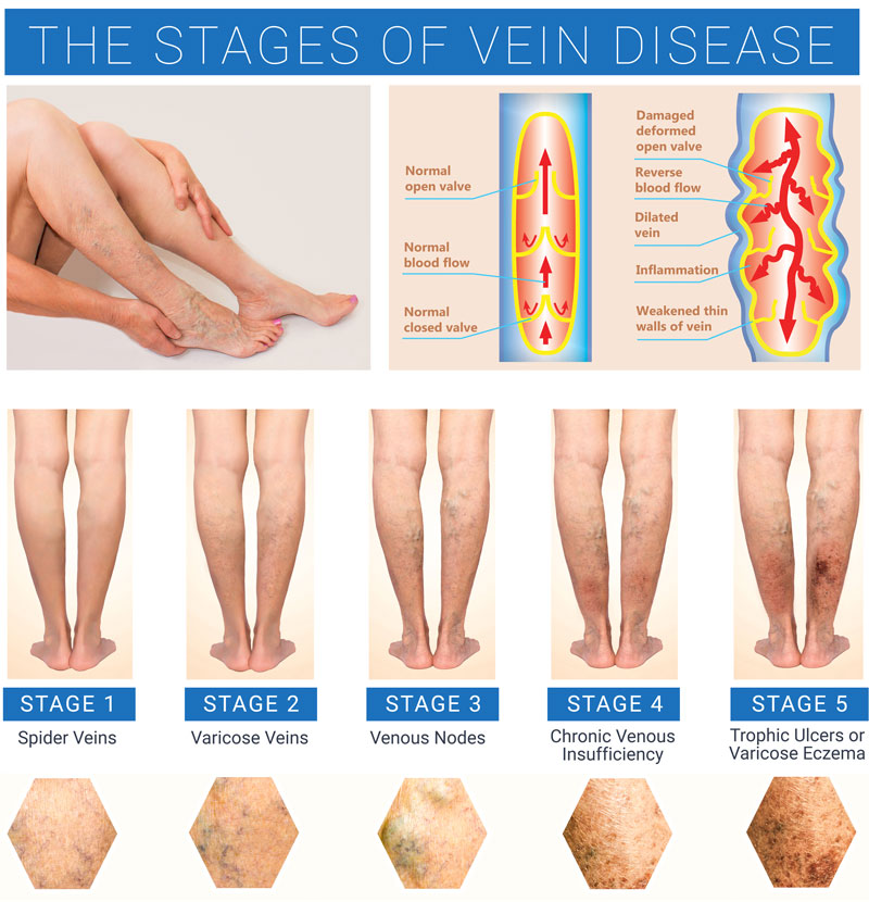 Varicose Veins Symptoms