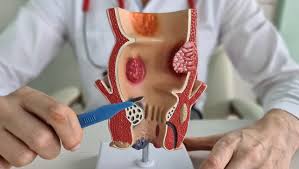 Piles Symptoms