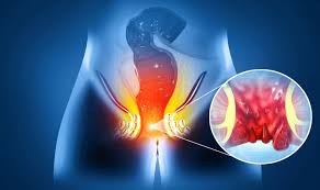 Anal Fistula Symptoms
